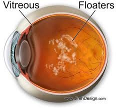 An example of eye floaters