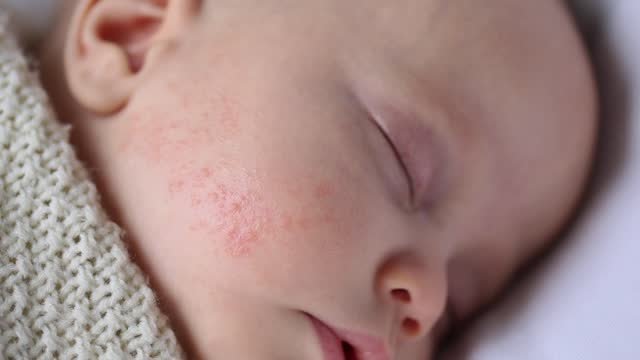 A baby with a rash on its face.
